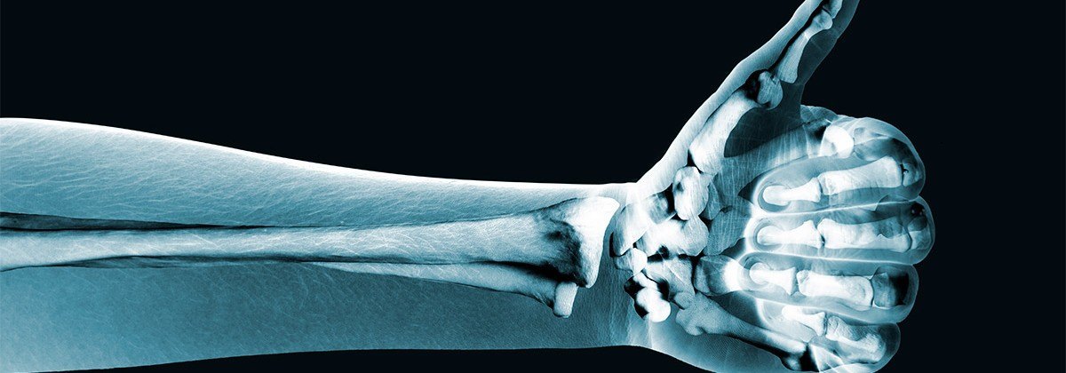 Osteoporosi. Coneix la malaltia i com es tracta