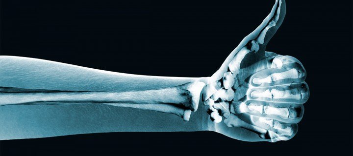 Osteoporosi. Coneix la malaltia i com es tracta